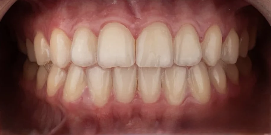 Antes do clareamento dental