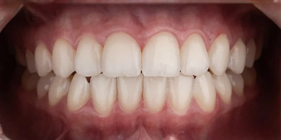Depois do clareamento dental